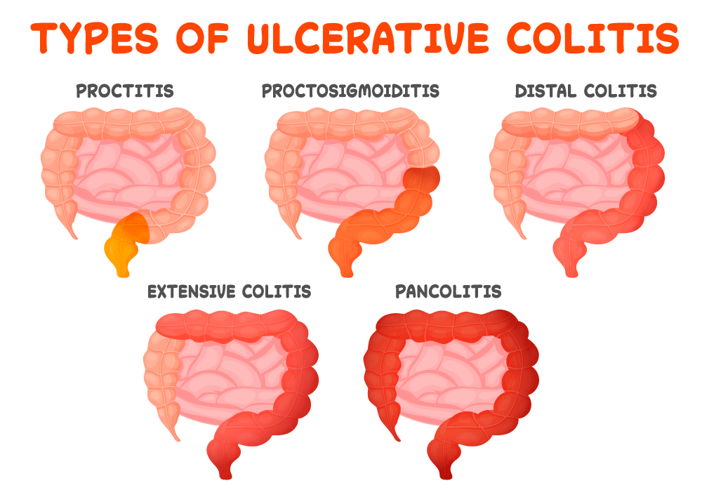 Ulcerative ColitisDRHC Dubai Gastroenterology Clinic